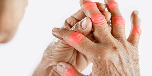 Rheumatoid-Arthritis